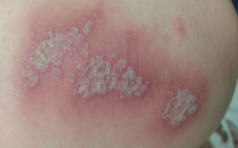 Bieu Hien Viem Da Tiep Xuc Do Con Trung