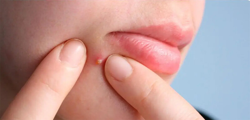 Có nên nặn mụn mủ không? Làm sao để hết mụn mủ nhanh nhất 2 - 2 Có nên nặn mụn mủ không? Câu trả lời từ các chuyên gia là KHÔNG.