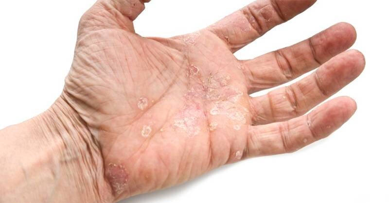 7 Cách dưỡng da lòng bàn tay bị khô ráp nhanh mềm mịn tại nhà đơn giản 1 - 1 Da lòng bàn tay bị khô ráp là dấu hiệu của làn da thiếu độ ẩm.