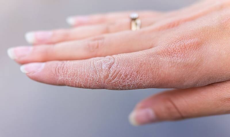 Da ngón tay bị nhăn khô nứt khi vào mùa đông.