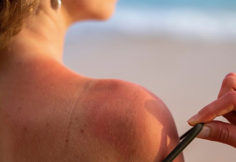 Viêm da tiếp xúc ánh sáng: Nguyên nhân và cách điều trị 3 - 3 Dau Hieu Viem Da Tiep Xuc Anh Sang