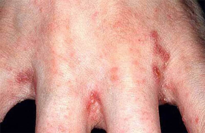 Ghẻ chàm hóa: Nguyên nhân, triệu chứng và cách điều trị hiệu quả 3 - 3 Hình ảnh ghẻ chàm hóa ở tay.