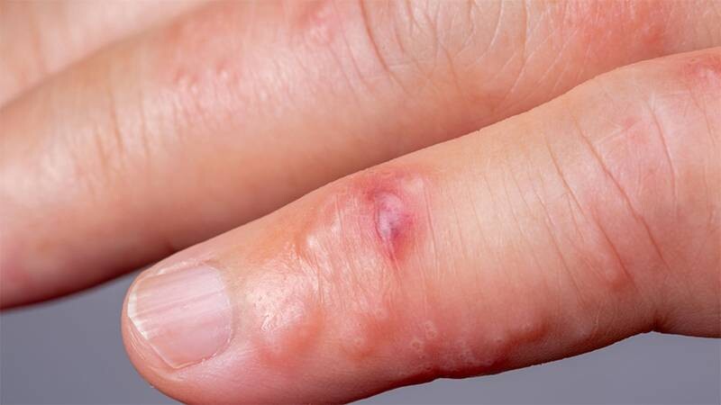 Ghẻ chàm hóa: Nguyên nhân, triệu chứng và cách điều trị hiệu quả 5 - 5 Giữ vệ sinh để hạn chế bị tái phát tình trạng ghẻ chàm hóa.