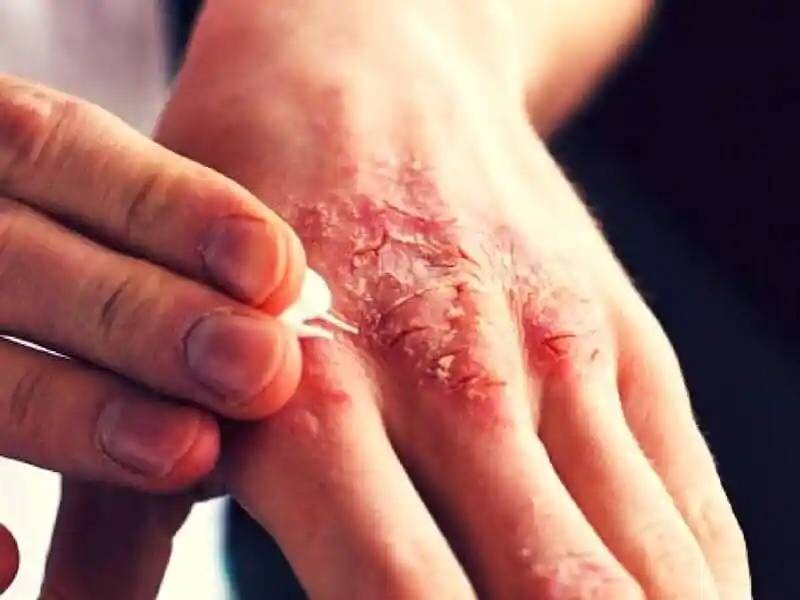 Ghẻ chàm hóa: Nguyên nhân, triệu chứng và cách điều trị hiệu quả 4 - 4 Sử dụng thuốc và tuân thủ theo phác đồ điều trị của bác sĩ để dứt điểm tình trạng ghẻ chàm hóa.