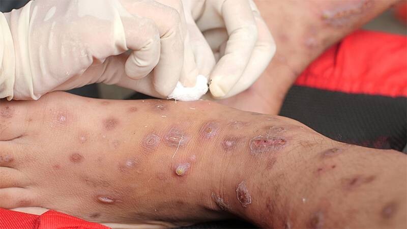 Ghẻ nước ở chân là gì và cách trị nhanh khỏi 1 - 1 Hình ảnh ghẻ nước ở chân chân thực.