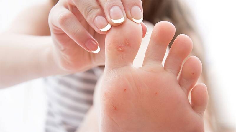 Ghẻ nước ở chân là gì và cách trị nhanh khỏi 2 - 2 Đặc điểm ghẻ nước ở chân so với các vùng da khác.