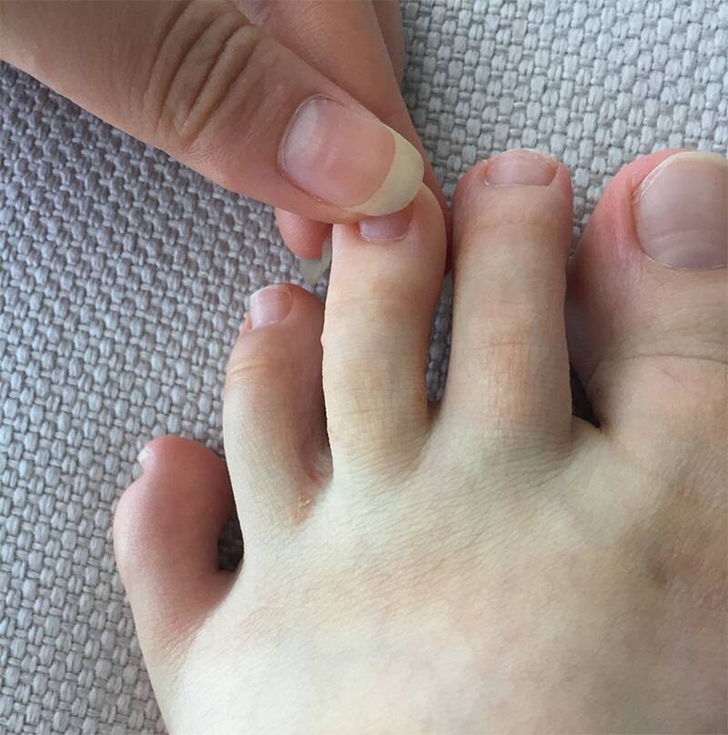 Ghẻ nước ở chân là gì và cách trị nhanh khỏi 4 - 4 Điều trị ghẻ nước ở ngón chân đúng cách sẽ khỏi sau 2-6 tuần.