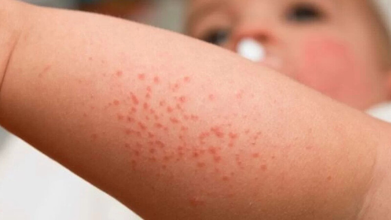Ghẻ ở trẻ em: Dấu hiệu, triệu chứng và cách điều trị 1 - 1 Bệnh ghẻ ở trẻ em là gì?