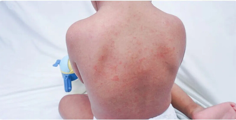 Ghẻ ở trẻ em: Dấu hiệu, triệu chứng và cách điều trị 3 - 3 Hình ảnh bệnh ghẻ trẻ em ở lưng.