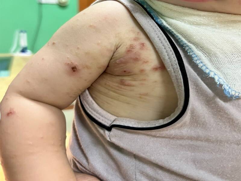 Ghẻ ở trẻ em: Dấu hiệu, triệu chứng và cách điều trị 4 - 4 Tìm hiểu các nguyên nhân khiến trẻ bị ghẻ.