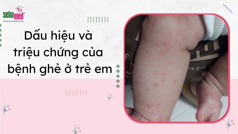 Ghẻ ở trẻ em: Dấu hiệu, triệu chứng và cách điều trị 5 - 5 Dấu hiệu và triệu chứng của bệnh ghẻ ở trẻ em.