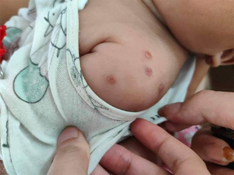 Ghẻ ở trẻ em: Dấu hiệu, triệu chứng và cách điều trị 6 - 6 Tìm hiểu các cách chữa bệnh ghẻ ở trẻ em.