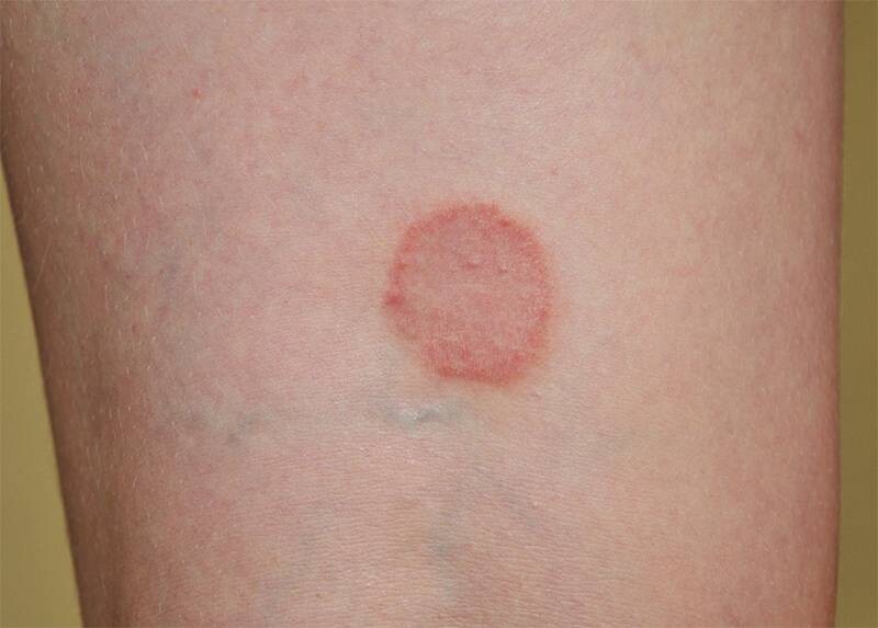 Hắc lào là gì? Hắc lào có nguy hiểm không?