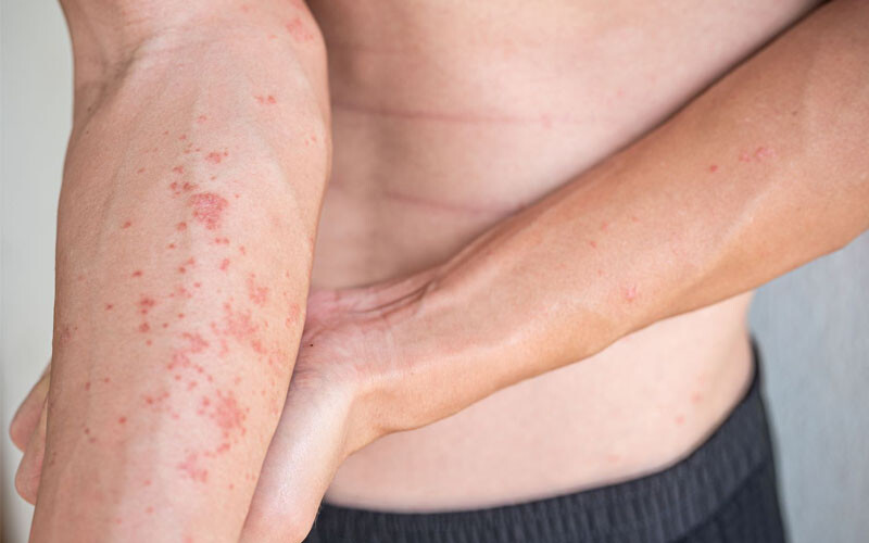 Viêm da tiếp xúc dị ứng bao lâu thì khỏi? Kiêng ăn gì? 2 - 2 Hinh Anh Viem Da Tiep Xuc Di Ung