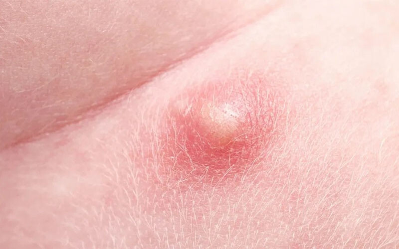 Moc Mun O Vung Kin La Gi