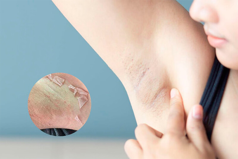 Nách bị khô và tróc da là gì?