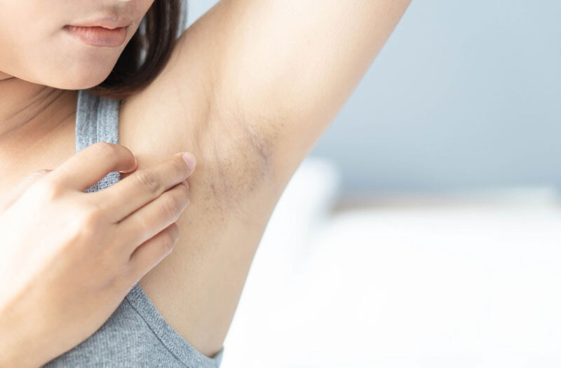 Tìm hiểu các nguyên nhân khiến nách bị khô và tróc da.