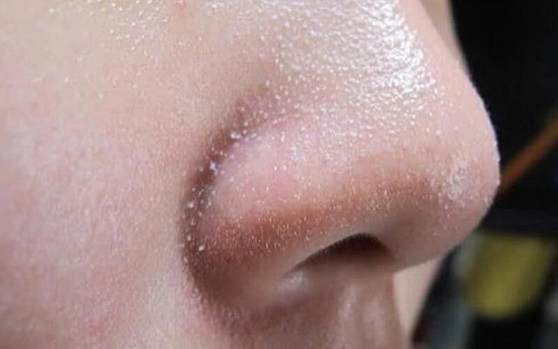 Sợi bã nhờn ở mũi là gì? Có nguy hiểm không?