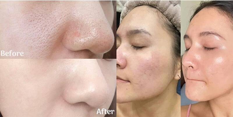 Tẩy da chết bằng BHA (Salicylic Acid) đặc trị sợi bã nhờn cánh mũi.