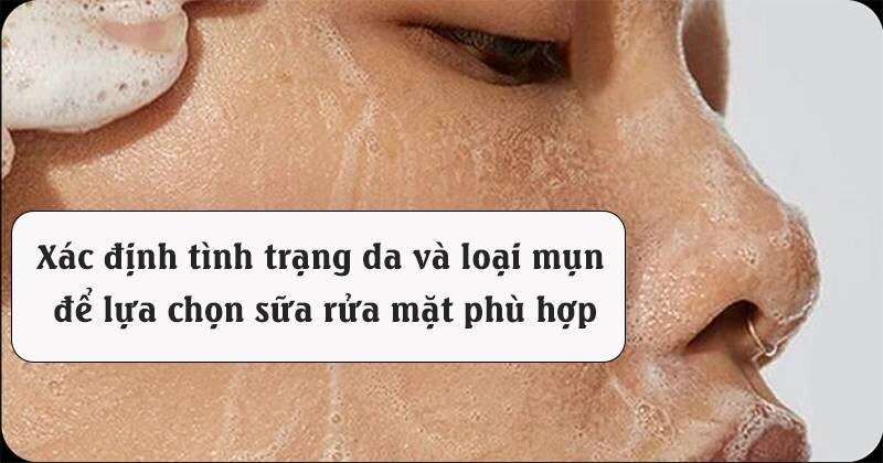 Sữa rửa mặt có trị mụn không? Đặc điểm sữa rửa mặt trị mụn cho từng loại da.