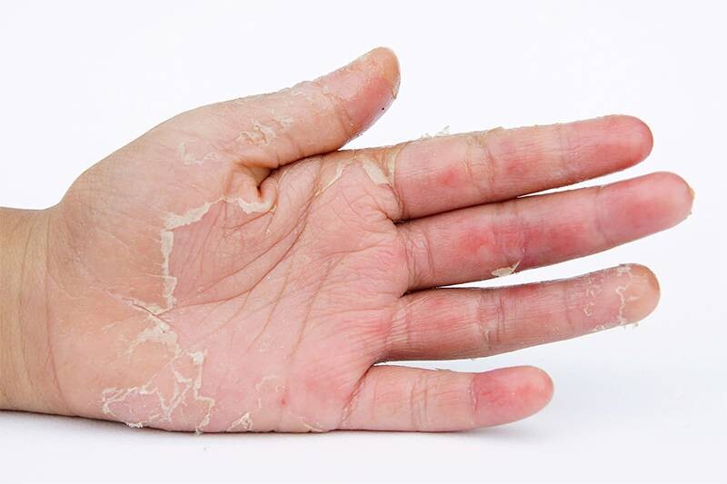 Tay khô bị tróc da do viêm da tiếp xúc có thể bong thành từng mảng.