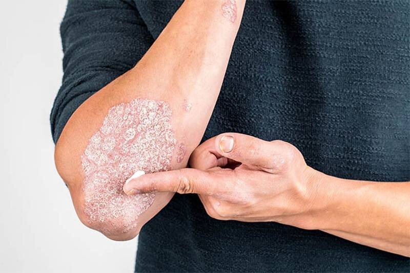 Da tay bị khô tróc vảy do ảnh hưởng của bệnh Chàm Eczema.