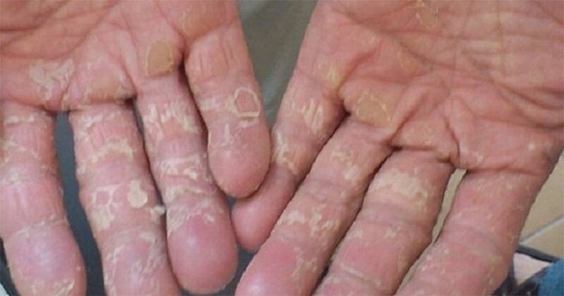 Tay khô tróc da có thể do bị tác dụng phụ của thuốc.