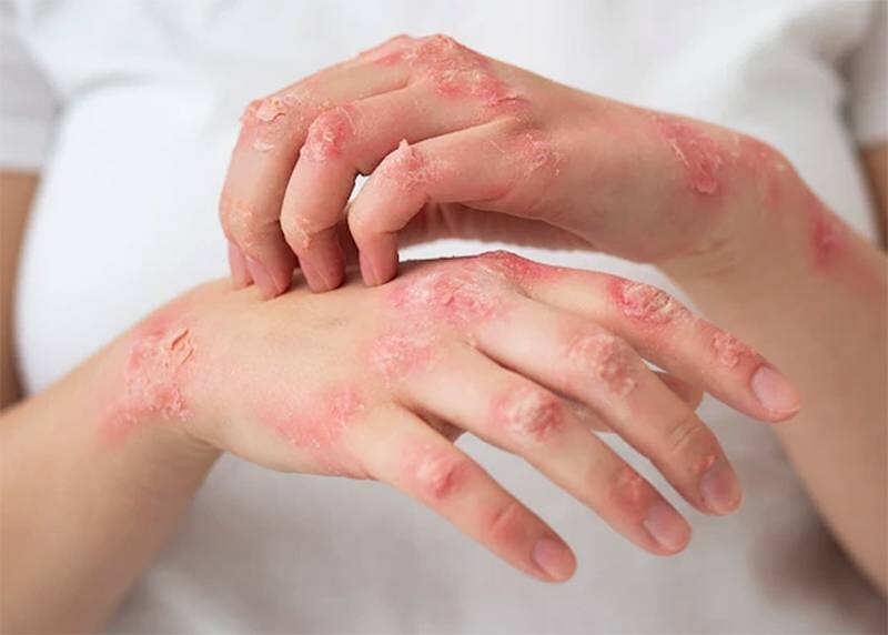 Vảy nến (Psoriasis) có thể là nguyên nhân gây ra tay khô bong tróc vảy.