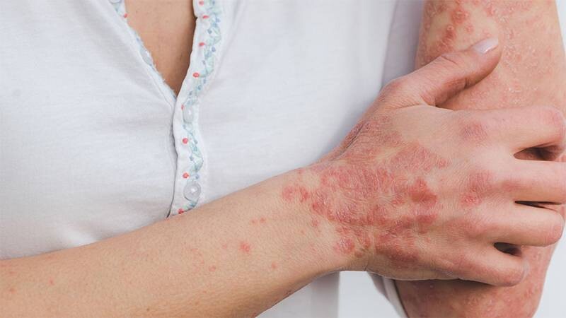 Da tay bị bong tróc vảy do nhiễm nấm.