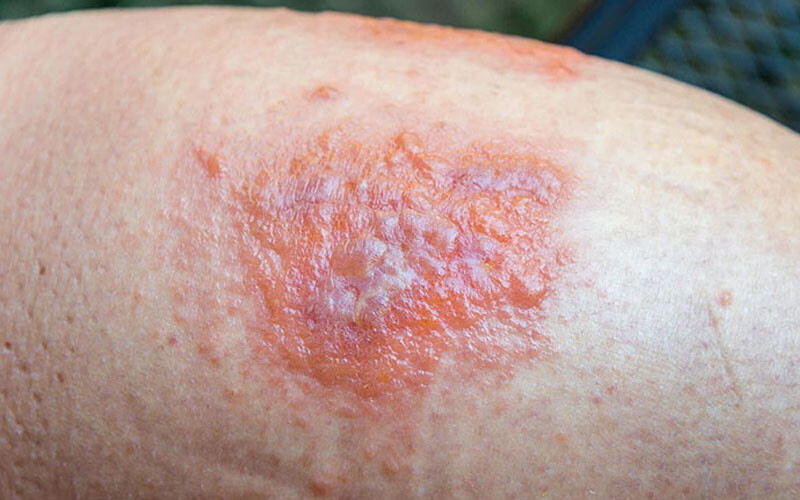 Viem Da Tiep Xuc Do Con Trung Co Nguy Hiem Khong