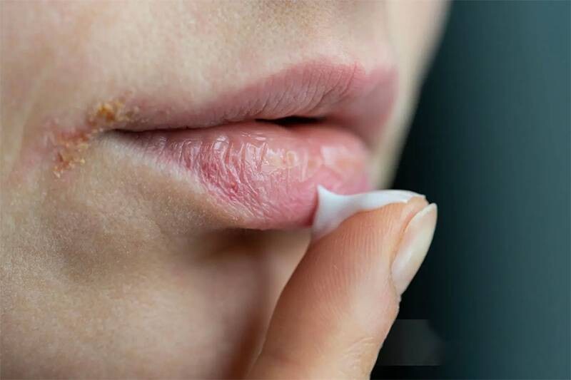 Vùng da quanh miệng bị khô rát do đâu? Cách trị hiệu quả tại nhà 5 - 5 Dưỡng ẩm cho vùng da quanh miệng bị khô rát để da đủ ẩm hơn.