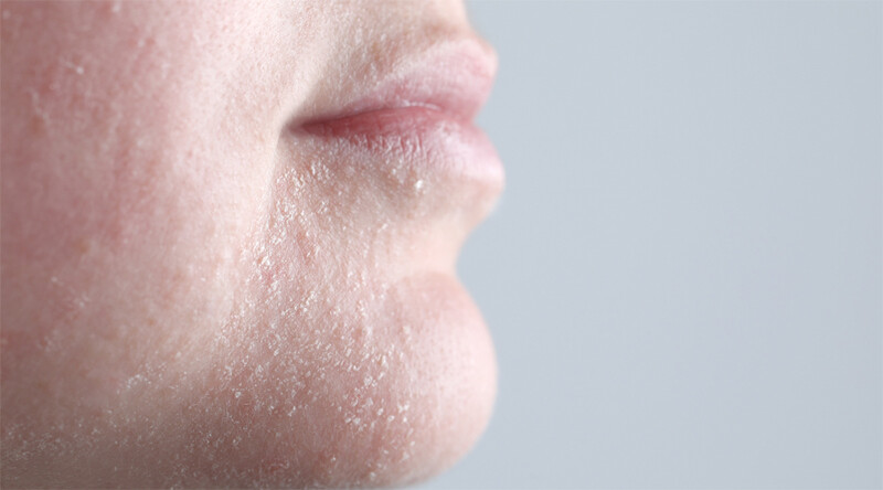 Vùng da quanh miệng bị khô rát do đâu? Cách trị hiệu quả tại nhà 2 - 2 Da khô, thiếu nước là nguyên nhân chính gây ra tình trạng vùng da quanh miệng bị khô rát.