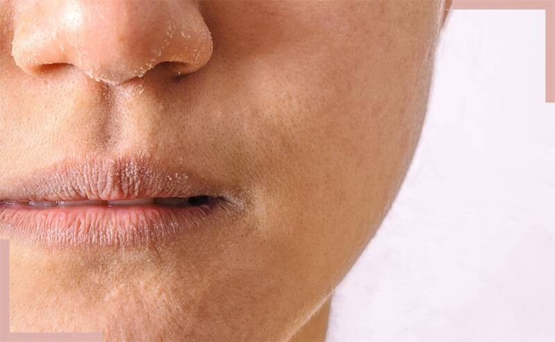 Vùng da quanh miệng bị khô rát do đâu? Cách trị hiệu quả tại nhà 3 - 3 Bị khô vùng da quanh miệng có thể khiến các bạn cảm thấy da căng tức, nứt mẻ chảy máu, đóng vảy.