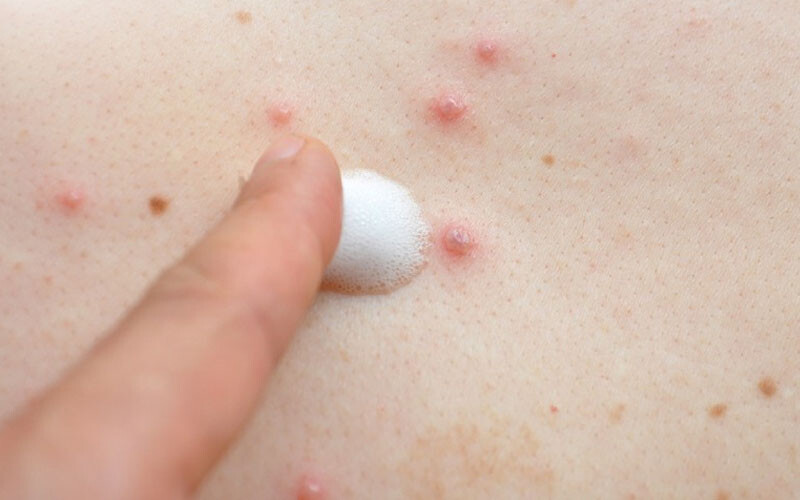 Xử lý mụn thịt ở lưng nhanh chóng, hiệu quả 3 - 3 Cach Tri Mun Thit O Lung