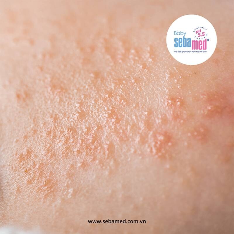 Chàm sữa là gì và vì sao trẻ dễ mắc? Chàm sữa có tự hết không?