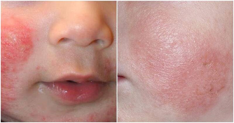 Chàm sữa có tự hết không? Những trường hợp chàm sữa khó tự khỏi.