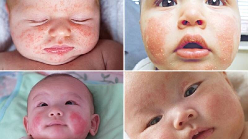 Chàm sữa có tự hết không? Có nên dùng thuốc khi chàm sữa chưa tự khỏi?