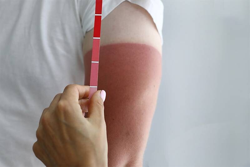 Da bị cháy nắng sạm đen là gì?