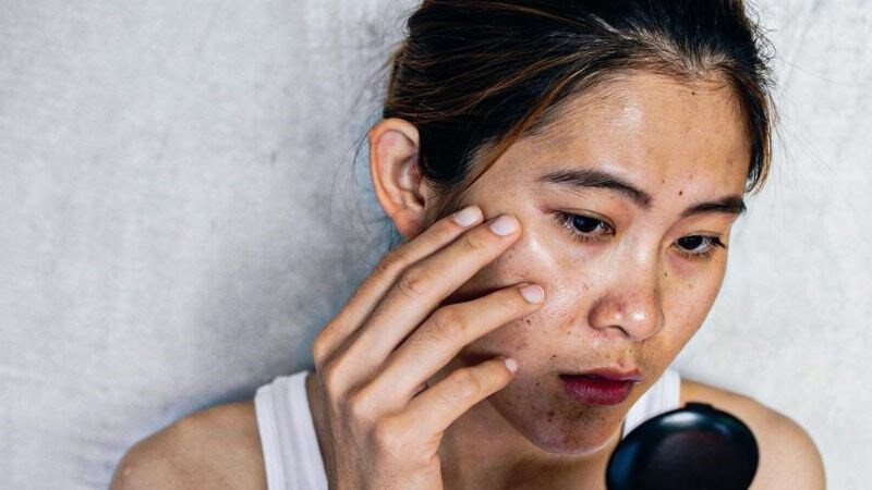 Da bị cháy nắng sạm đen mất bao lâu phục hồi?