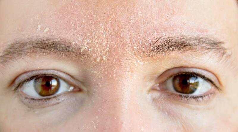 Da bị khô tróc vảy là gì?