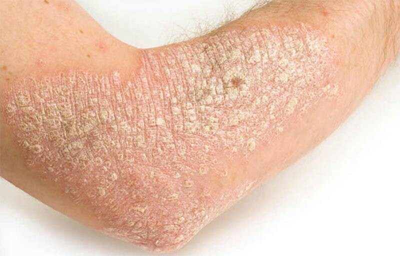 Da bị khô tróc vảy có thể là dấu hiệu của một số bệnh lý về da như chàm, viêm da tróc vảy,...