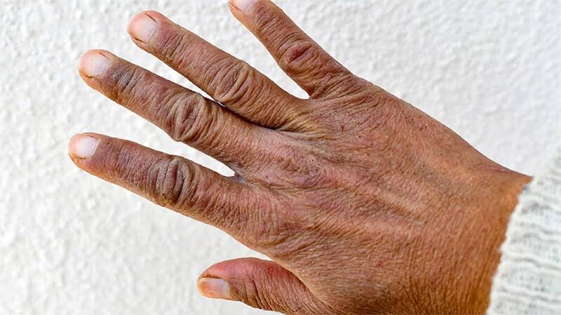 Mách bạn 5 cách chăm sóc da tay nhăn nheo và khô hiệu quả 5 - 5 Một số trường hợp da tay nhăn nheo và khô nặng cần bôi và uống thuốc theo đơn bác sĩ.