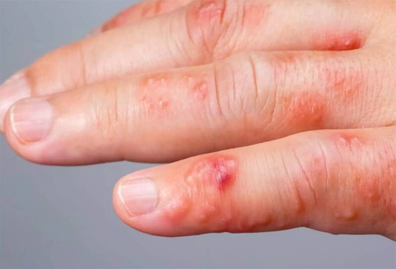 Ghẻ nước ở tay: Nguyên nhân, triệu chứng và cách điều trị nhanh khỏi 2 - 2 Tìm hiểu các loại ghẻ nước ở tay phổ biến.