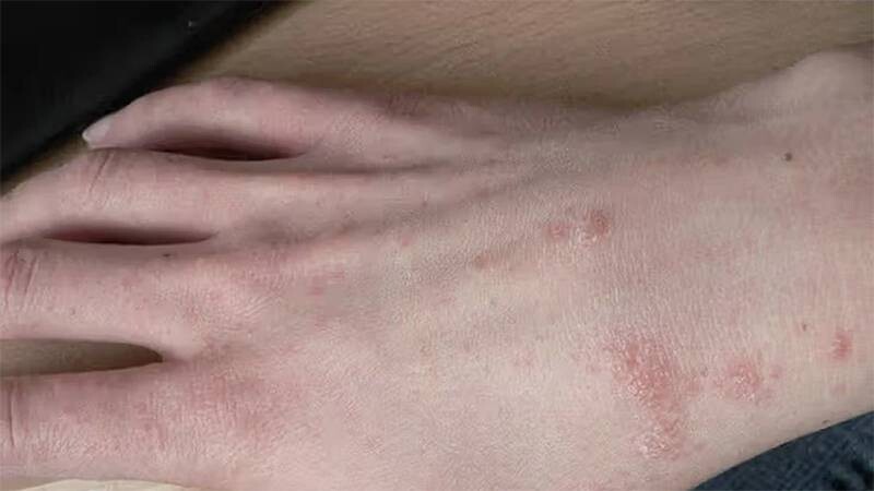 Ghẻ nước ở tay: Nguyên nhân, triệu chứng và cách điều trị nhanh khỏi 4 - 4 Các cách chữa ghẻ nước ở tay lành tính, nhanh khỏi.