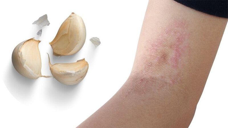 Chữa hắc lào bằng tỏi tại nhà đơn giản.