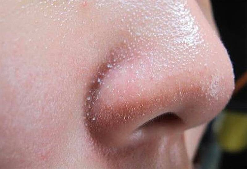 Tìm hiểu mụn cám là gì? Mụn cám có tự hết được không?