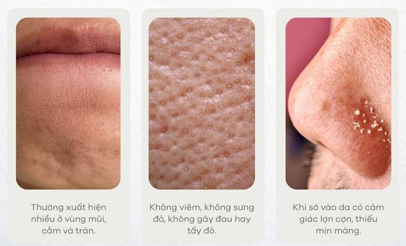 Dấu hiệu nhận biết mụn cám.