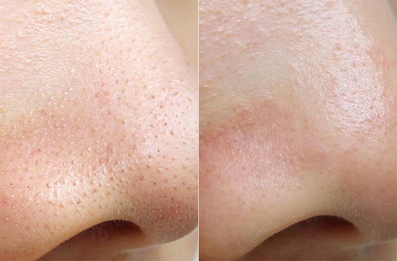 Mụn cám có tự hết không? Sử dụng đều đặn mặt nạ đất sét tuần 2 lần sẽ giúp nhanh gom cồi mụn cám.