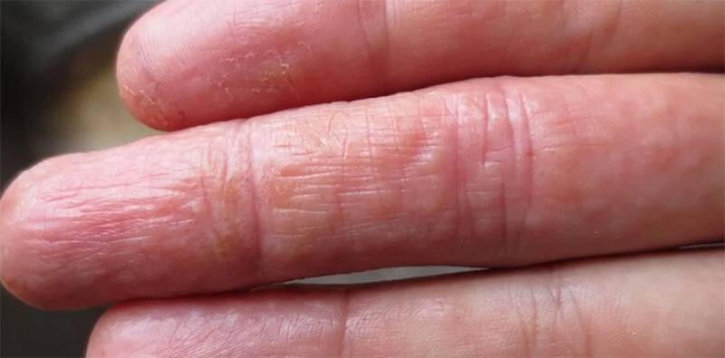 Ngứa đầu ngón tay có mụn nước là bị gì?