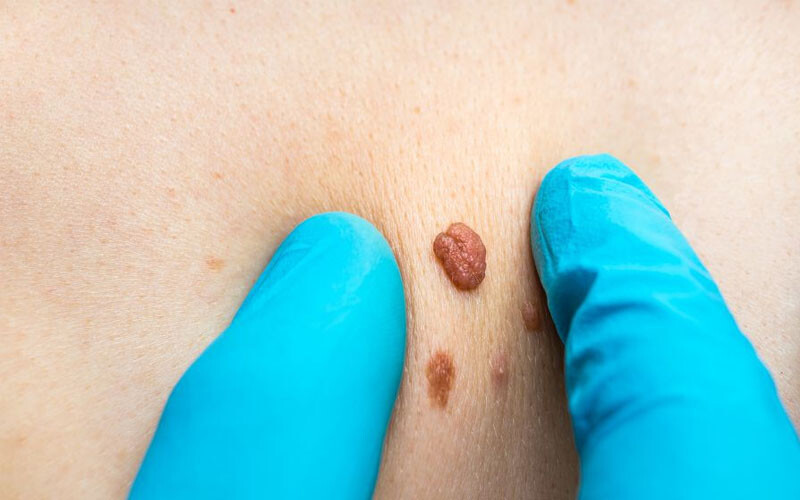 Xử lý mụn thịt ở lưng nhanh chóng, hiệu quả 2 - 2 Nguyen Nhan Mun Thit O Lung